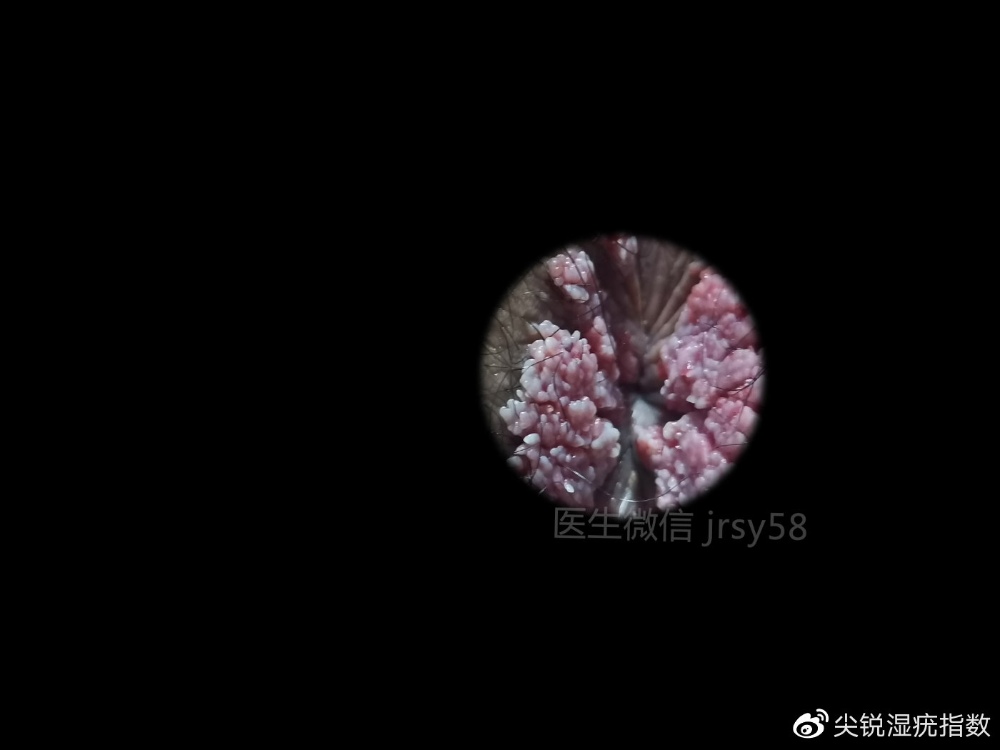 濕銳尖疣的確診方法，了解、預(yù)防與應(yīng)對(duì)，濕銳尖疣的確診方法，了解、預(yù)防與應(yīng)對(duì)策略
