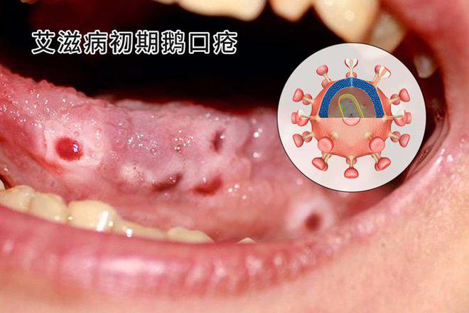 尖銳疣體，不處理疣體，能否轉(zhuǎn)陰？深度解析，尖銳疣體不處理疣體能否轉(zhuǎn)陰，深度解析與探討