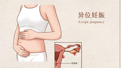 征兵過(guò)程中發(fā)現(xiàn)盆腔積液會(huì)有影響嗎？解讀相關(guān)問(wèn)題及其應(yīng)對(duì)策略，征兵過(guò)程中盆腔積液的影響解讀與應(yīng)對(duì)策略